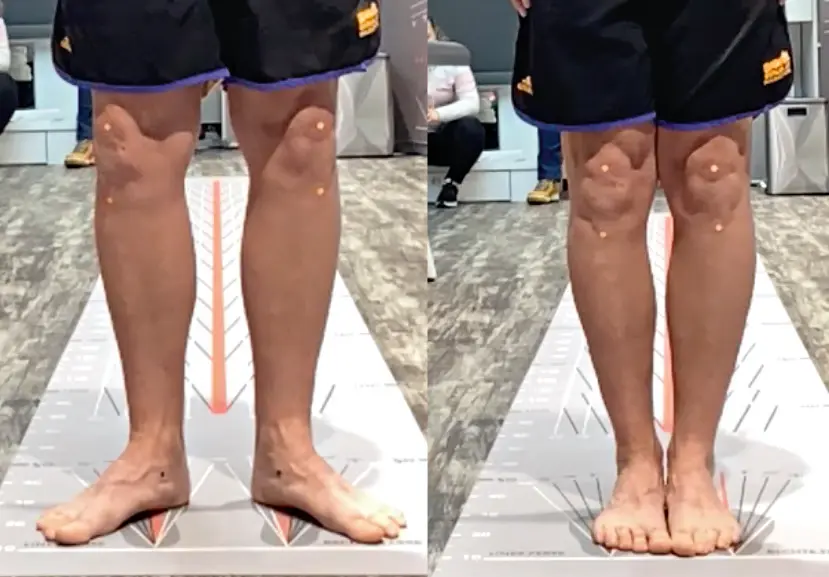 Knee alignment comparison